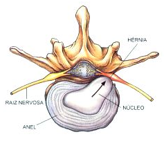 Hérnia de disco comprimindo a raiz nervosa